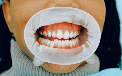 What are the Signs of Gum Disease?